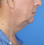 Natural Neck Lift