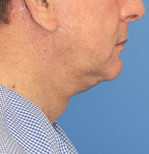 Natural Neck Lift Case 5213 After Photo Natural Neck Lift