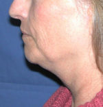 Natural Neck Lift