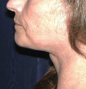 Natural Neck Lift Case 5189 After Photo Natural Neck Lift