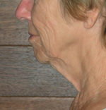 Natural Neck Lift