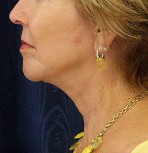 Natural Neck Lift Case 5216 After Photo Natural Neck Lift