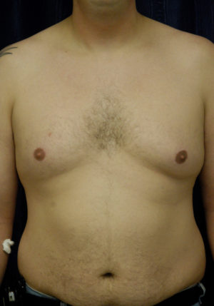 Gynecomastia