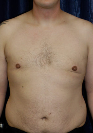 Gynecomastia