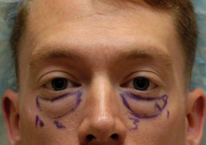 Eyelid (Blepharoplasty)