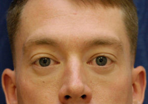 Eyelid (Blepharoplasty)