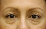 Eyelid (Blepharoplasty)