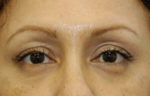 Eyelid (Blepharoplasty)