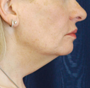 Natural Neck Lift Case 5269 Before Photo Natural Neck Lift