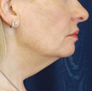 Natural Neck Lift