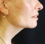 Natural Neck Lift