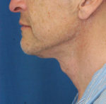 Natural Neck Lift