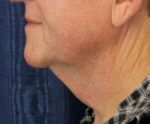 Natural Neck Lift