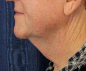 Natural Neck Lift Case 5271 Before Photo Natural Neck Lift