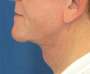 Natural Neck Lift Case 5271 After Photo Natural Neck Lift