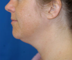 Submental Liposuction Case 5281 Before Photo Submental Liposuction