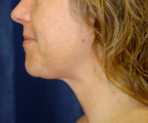 Submental Liposuction Case 5281 After Photo Submental Liposuction
