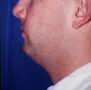 Submental Liposuction Case 5283 Before Photo Submental Liposuction