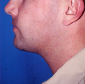 Submental Liposuction Case 5283 After Photo Submental Liposuction