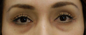 Injectables Case 5366 Before Photo Injectables