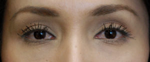 Injectables Case 5366 After Photo Injectables