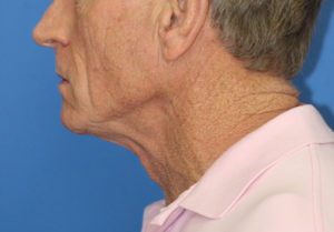 Natural Neck Lift