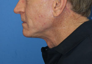 Natural Neck Lift