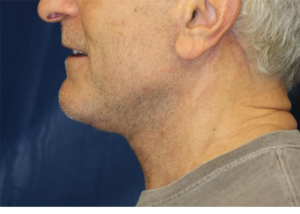 Natural Neck Lift