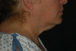 Natural Neck Lift