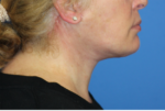 Natural Neck Lift