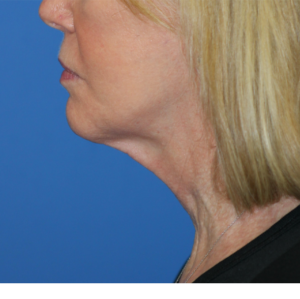 Natural Neck Lift