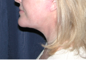 Natural Neck Lift