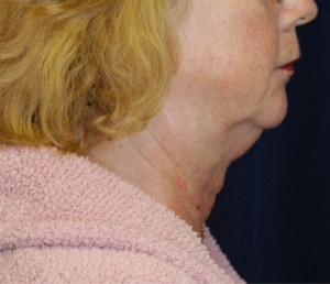 Natural Neck Lift