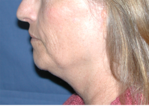 Natural Neck Lift