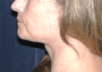 Natural Neck Lift