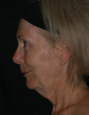 Natural Neck Lift