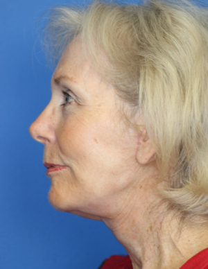 Natural Neck Lift