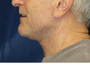 Natural Neck Lift