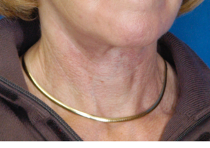 Natural Neck Lift