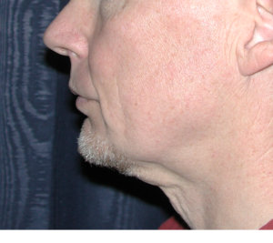 Natural Neck Lift