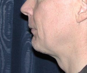 Natural Neck Lift