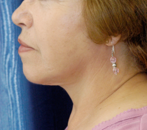 Natural Neck Lift Case 5602 After Photo Natural Neck Lift