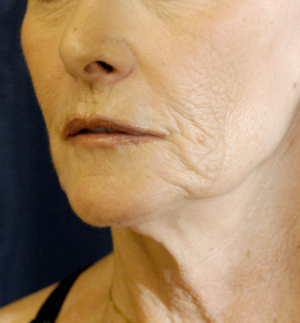 Natural Neck Lift