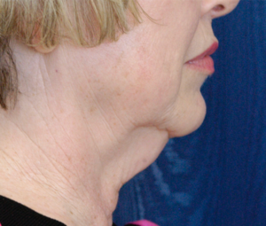 Natural Neck Lift