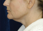 Natural Neck Lift