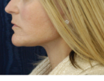 Natural Neck Lift