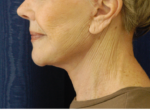 Natural Neck Lift