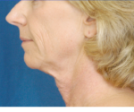 Natural Neck Lift