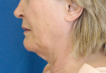 Natural Neck Lift