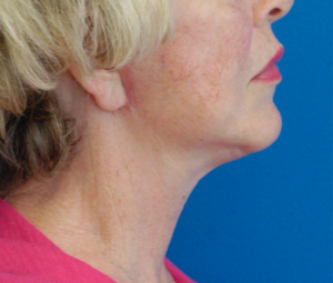 Natural Neck Lift